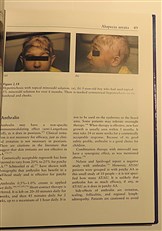 Hair Loss. Principles of Diagnosis and Management of Alopecia 