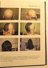 Hair Loss. Principles of Diagnosis and Management of Alopecia 